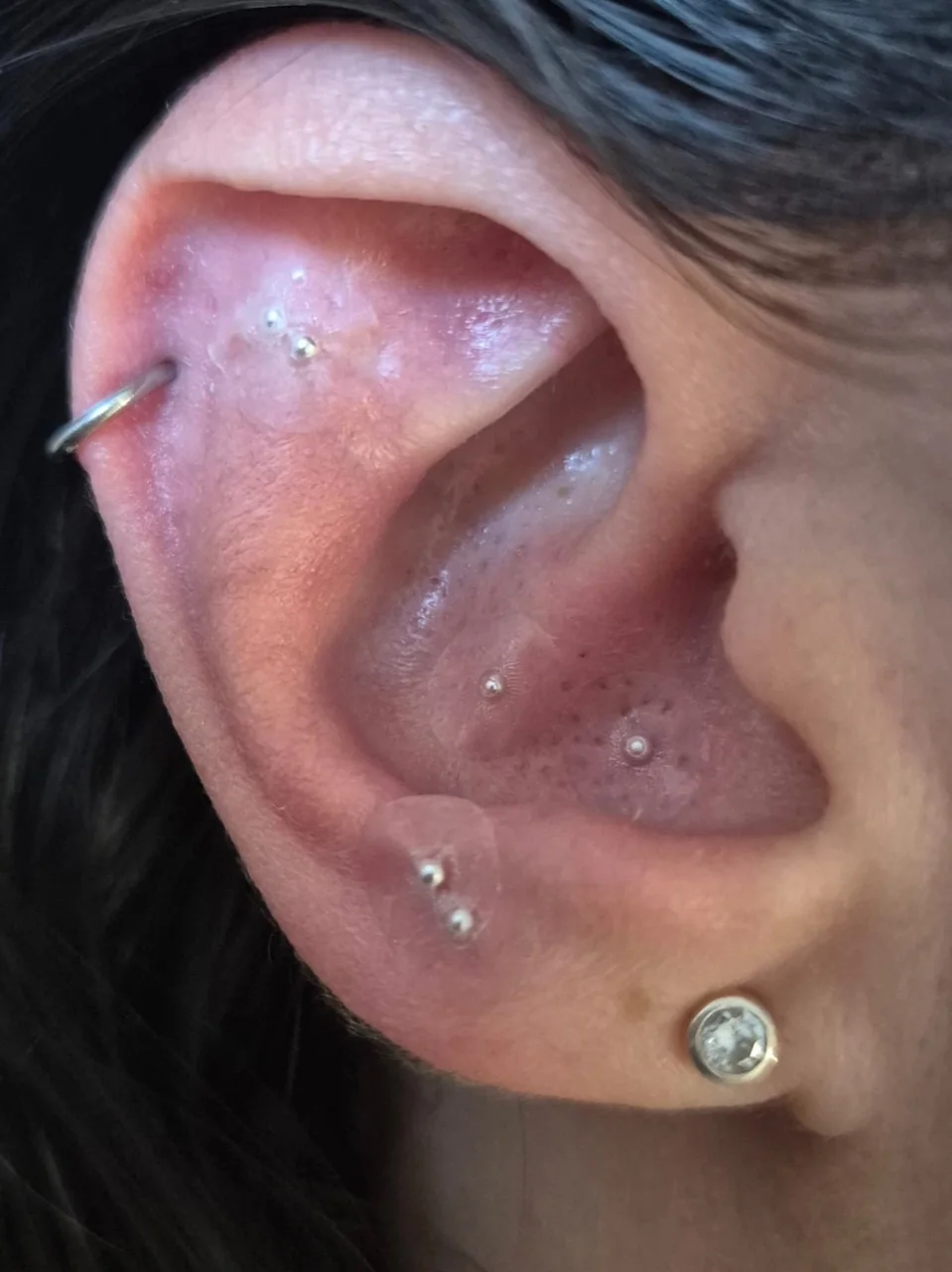 Silver-coloured ear seeds placed on the outer ear by Maxine at MAW Clinic