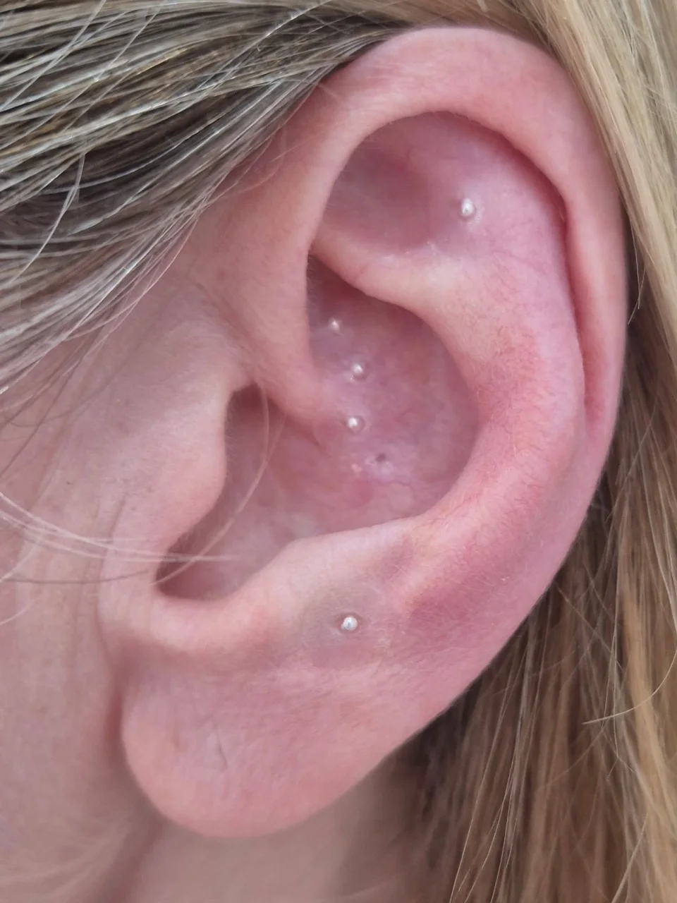 Close-up of ear seeds placed by Maxine at MAW Clinic