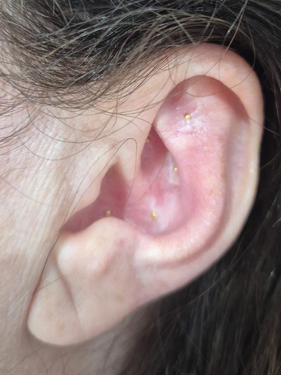Close-up of Maxine’s ear-seeding placement, example 4