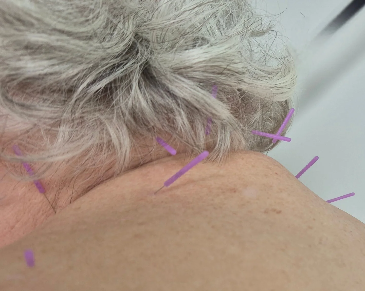 Original MAW Clinic photograph of acupuncture needle placement around the neck and shoulder