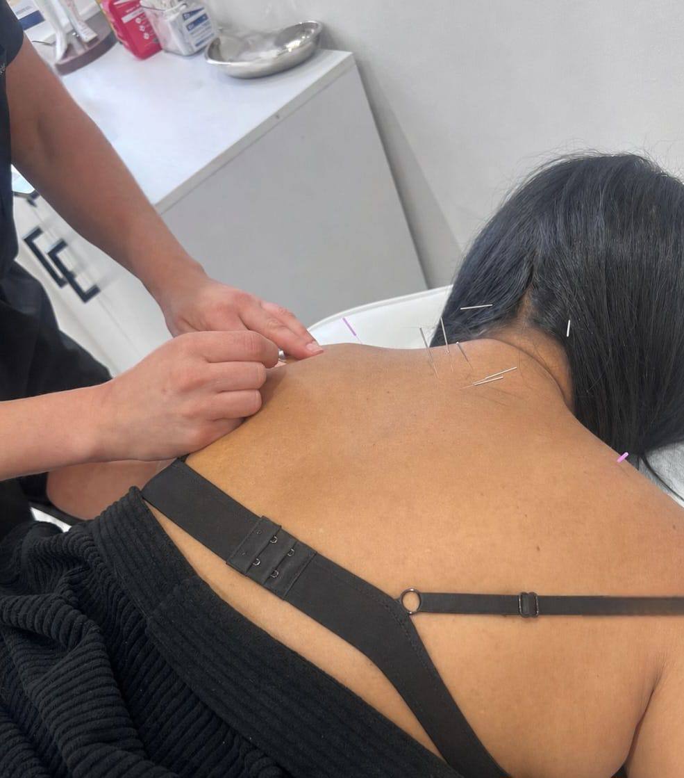 Acupuncture treatment for neck and shoulder tension