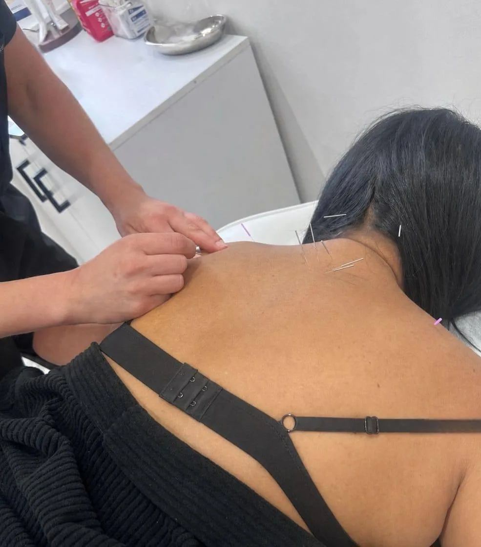 Acupuncture treatment for neck and shoulder tension